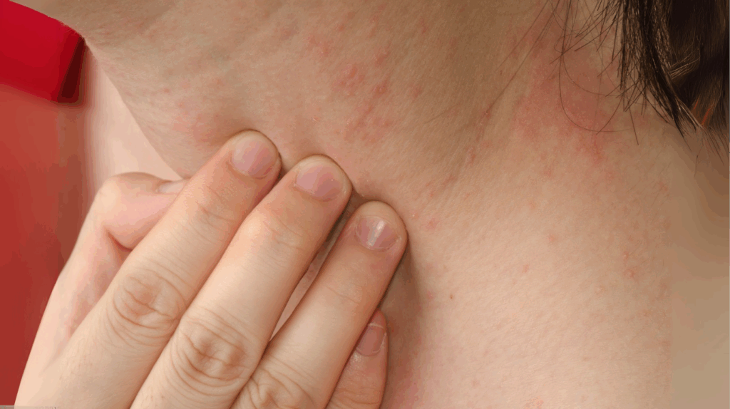 Visuel eczéma enfant