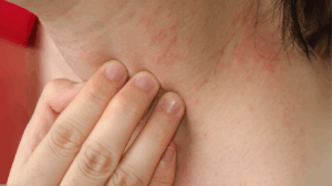 Visuel eczéma enfant