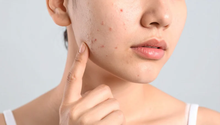 Visuel boutons acné