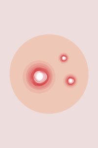 Dessin d'un bouton d'acné
