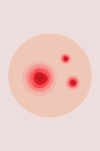 Schéma d'un bouton d'acné rouge.