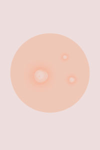 Schéma d'un bouton d'acné micro-kyste.